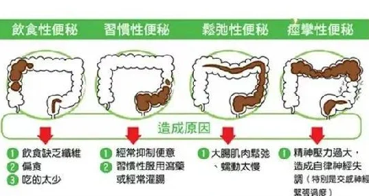 便秘constipation排便vk饮食调整和适度运动已见效排便频率有所改善